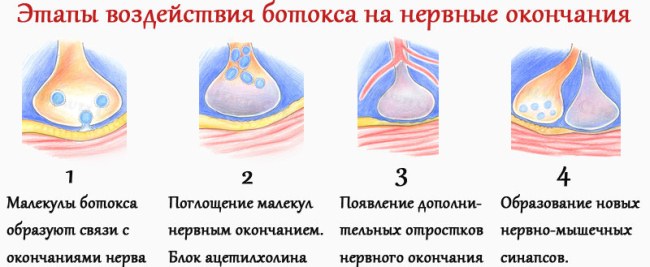 Уколы Ботокса в лоб. Результаты, фото до и после, последствия, отзывы